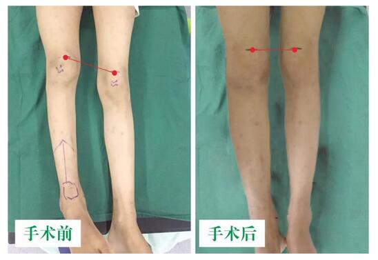 女孩墜梯右腿縮短5cm，幸得醫(yī)生及時(shí)診治恢復(fù)正常腿型
