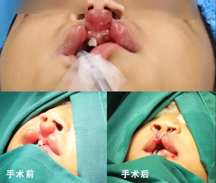 唇腭裂盡早治療消除孩子自卑心理，快樂成長！
