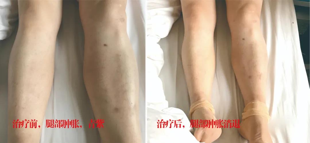 下肢靜脈血栓多年頑疾反復(fù)腫痛——疾病不容等待，早治療，早健康！