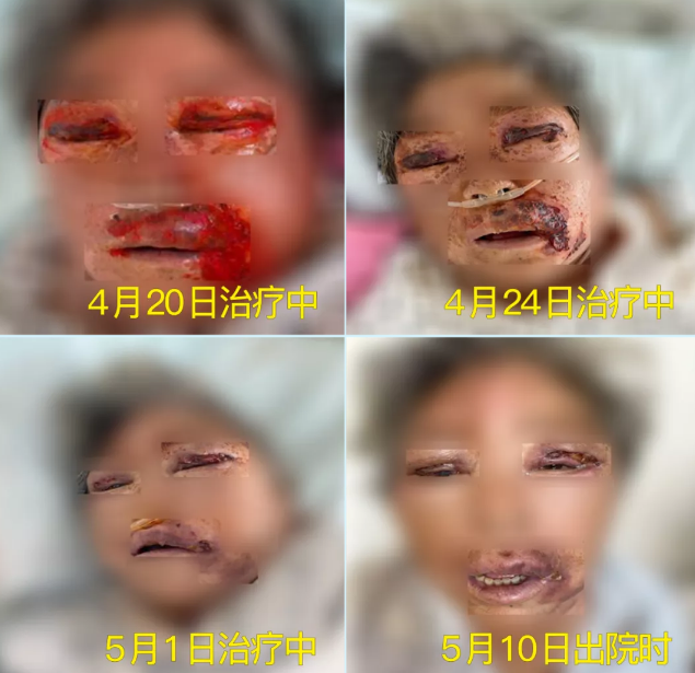 膿毒血癥（急性頜面部蜂窩組織炎）多學(xué)科聯(lián)合會診，幫助患者成功治愈！