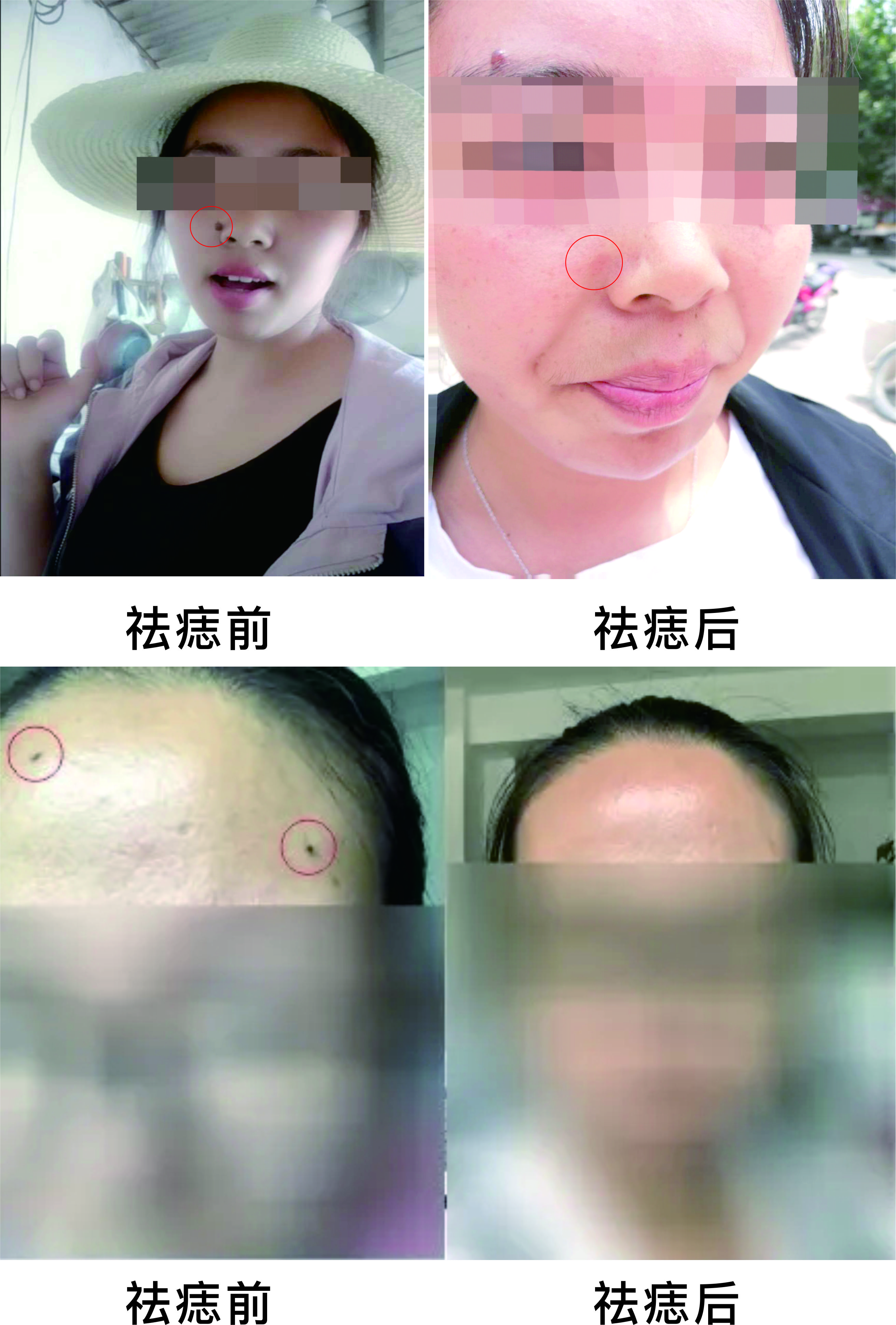 微波祛痣，告別臉部多余的“點(diǎn)綴”~