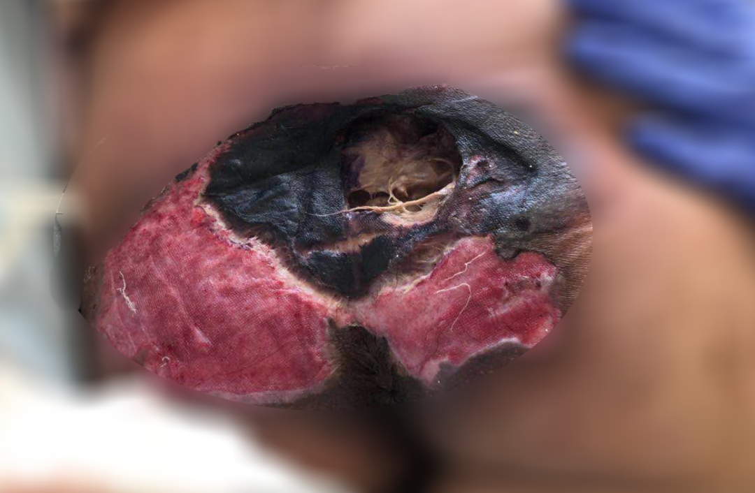 癱瘓3年的女患者臀部居然變成這樣?！