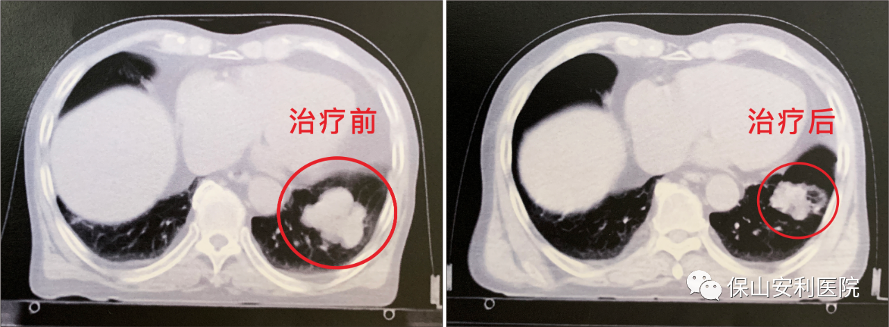 不做手術(shù)，早期肺癌也能根治！