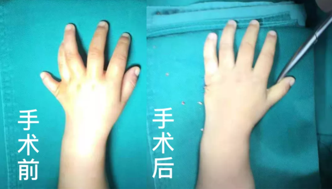 【保山安利醫(yī)院】2歲小兒手、足多指（趾）成功修復(fù)(矯正）！