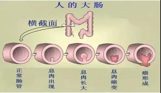 體檢發(fā)現(xiàn)腸息肉會癌變嗎？