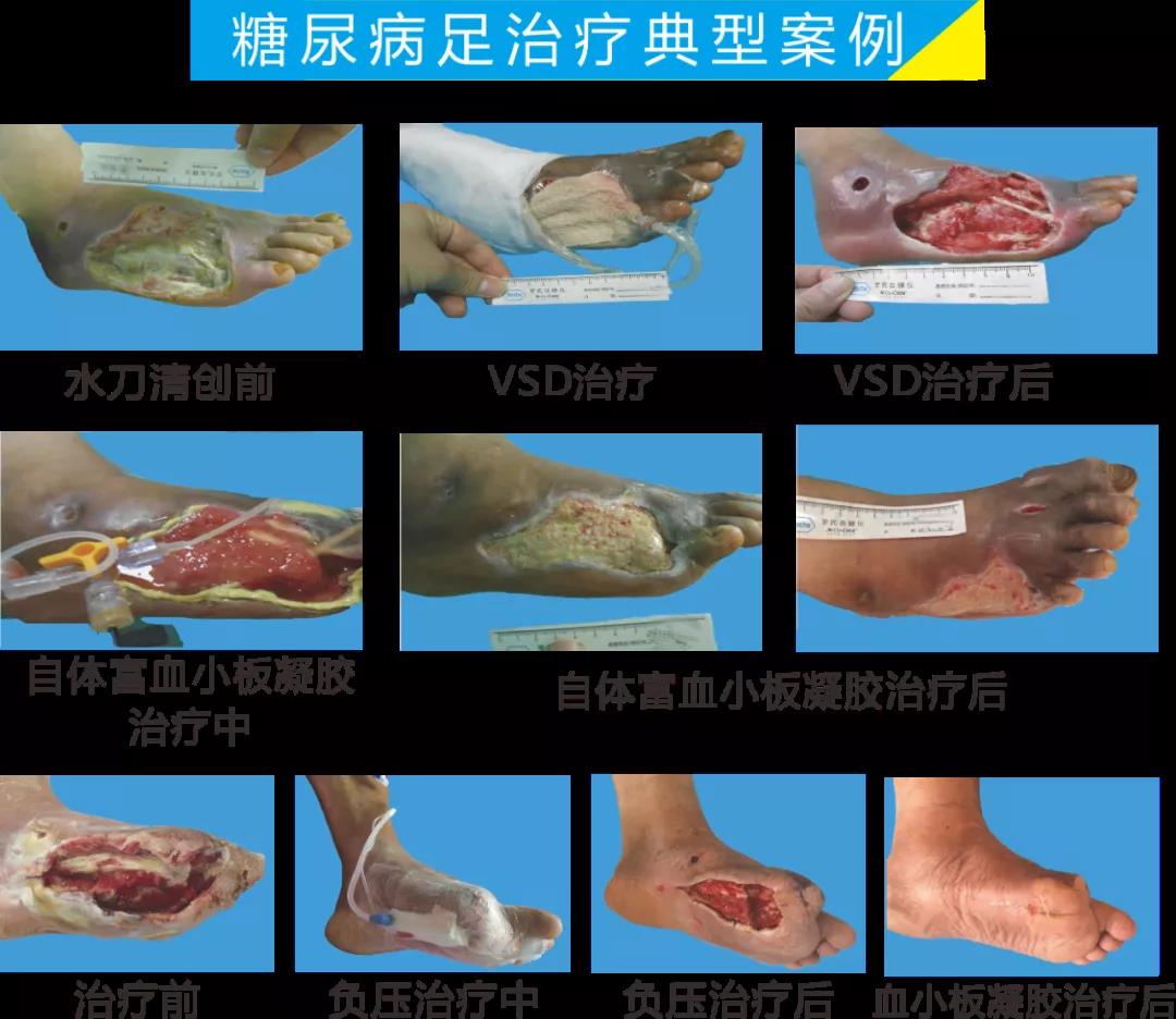 截肢、失明，甚至……，我們要做的是將糖尿病并發(fā)癥遏制在搖籃里！