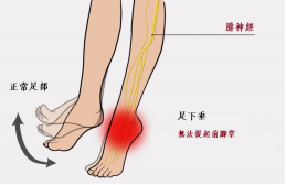 【保山安利醫(yī)院—健康科普】什么是足下垂！你了解嗎？
