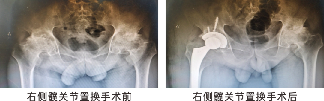 【保山安利醫(yī)院】長期飲酒導(dǎo)致雙側(cè)股骨頭壞死，髖關(guān)節(jié)置換后重獲運(yùn)動功能！